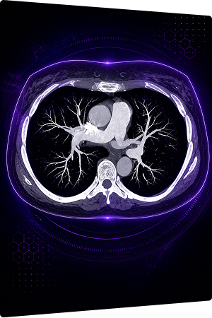 Chest CT — Pulmonary Vessels