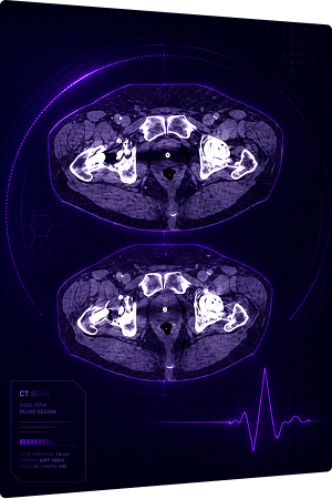 Pelvis CT — Axial View